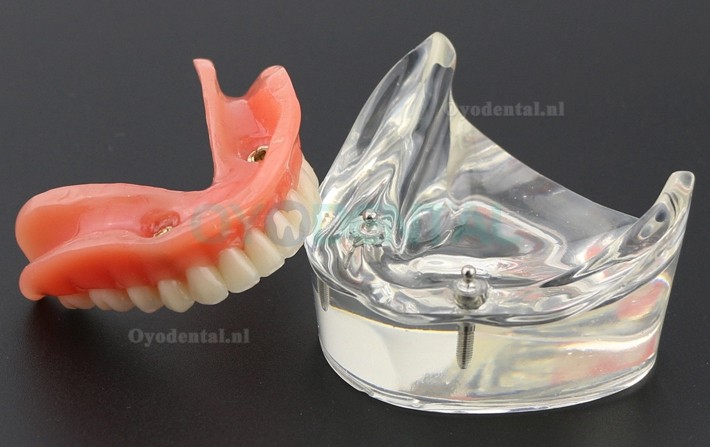 Tandentandenmodel Overdenture Inferieur met 2 implantaten Studiedemo Model 6002 01